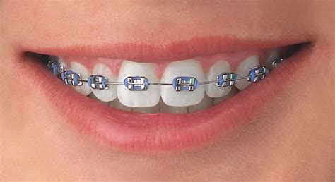 BRACKETS MINI 